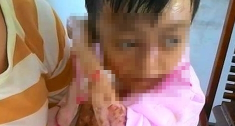 Nhà nghèo, bé gái 8 tuổi đau đớn sống cảnh bong từng mảng thịt