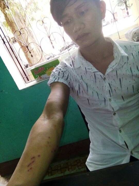 Đối tượng Bùi Quốc Nam đưa cánh tay bị cháu H. cào xước nhiều chỗ khi Nam hiếp dâm cháu H.