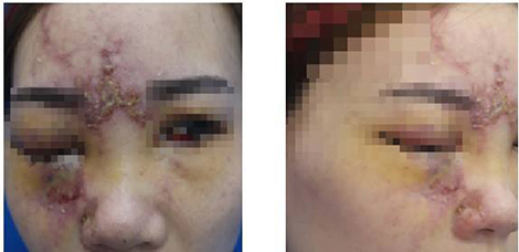 Cô gái 27 tuổi bị mù một mắt sau khi tiêm filler nâng mũi ở spa tại Đài Loan.