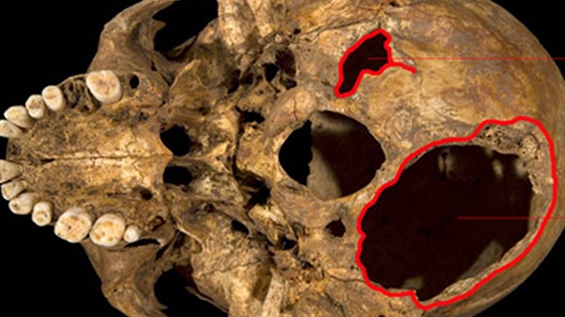 ADN giải mã cái chết thảm khốc của “ông Vua gù” nước Anh