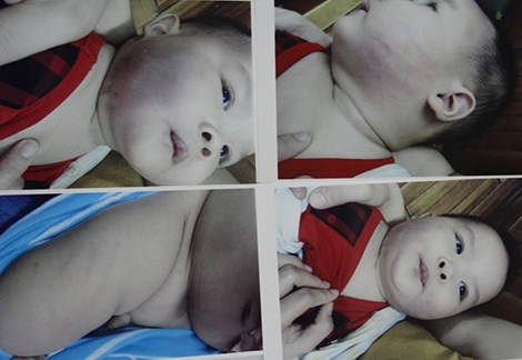 Bé 8 tháng tuổi phải vào viện cấp cứu vì nghi bị bạo hành