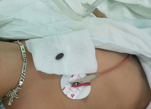 Kinh hãi "gắp" hạt dưa trong phế quản bé trai 3 tuổi 