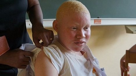 Nhiều chính trị gia muốn sở hữu bộ phận cơ thể người bạch tạng để lấy hên