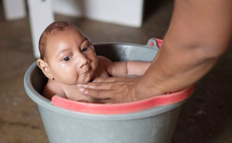 Brazil: Dịch Zika bùng nổ, ngày càng nhiều trẻ em bị dị tật bẩm sinh