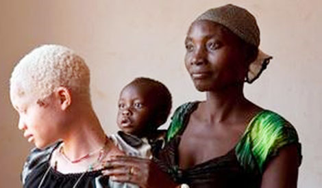 Nạn săn người bạch tạng  "tăng nhiệt" ở Malawi