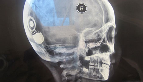 Cấy ghép ốc tai điện tử thành công cho hai bệnh nhi khiếm thính đầu tiên