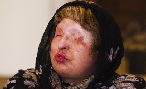 Tội phạm dùng axít tấn công phụ nữ ngày càng gia tăng