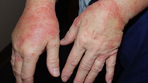 Nguy hiểm từ dung dịch rửa tay không cần nước