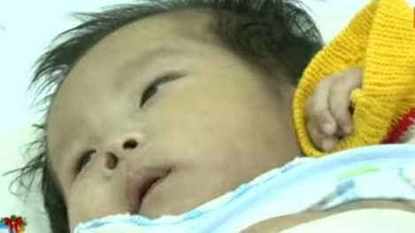Ca mổ tim kỳ diệu cho bệnh nhi 17 ngày tuổi ở Hà Nội