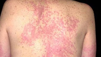 Dị ứng với nước, căn bệnh cực hiếm trên thế giới