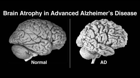 Những biến chứng phức tạp có thể xảy ra với người bệnh Alzheimer?
