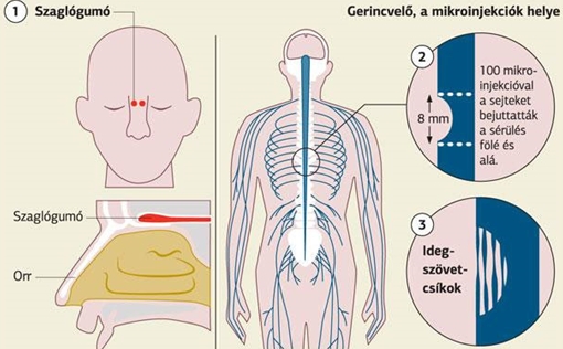 Cấy ghép tế bào giúp bệnh nhân liệt hồi phục vận động