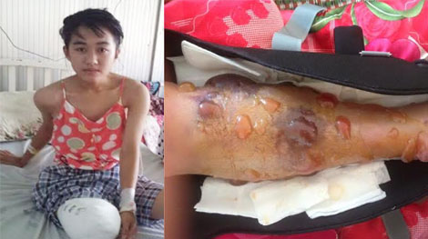 Họp hội đồng y khoa xác định nguyên nhân nữ sinh bị cưa chân