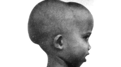 Khám sức khỏe tiền hôn nhân để phòng tránh bệnh tan máu bẩm sinh