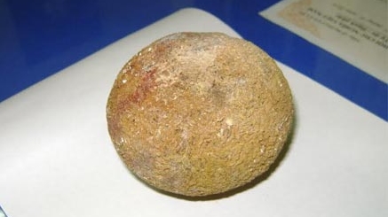 Viên sỏi thận nặng 400g trong người một bệnh nhân