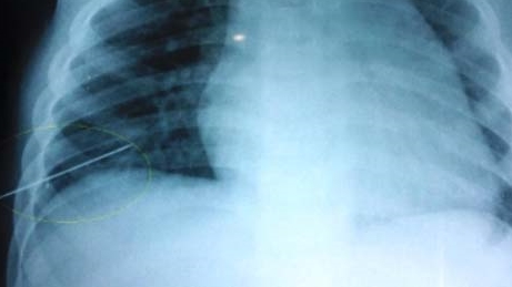 Mẹ rơi kim, con bị đâm thủng phổi