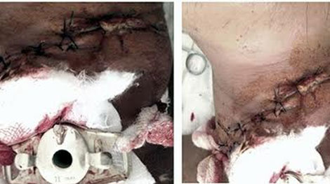 Can hàng xóm đánh vợ bị đứt lìa khí quản