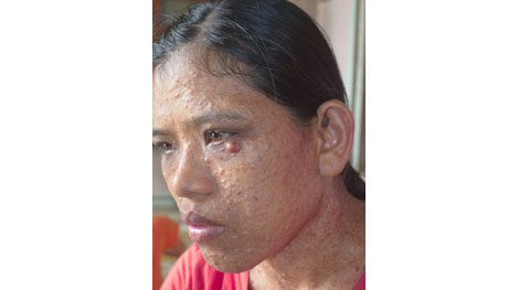 Người phụ nữ 'da cóc' cần được giúp đỡ