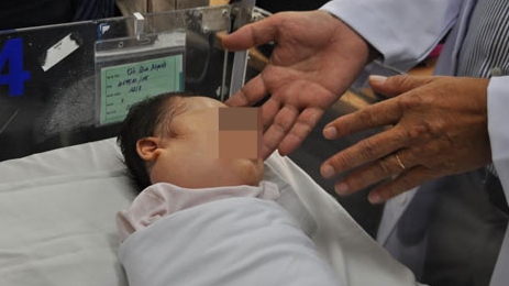 Làm tan khối bướu 'khổng lồ' không cần phẫu thuật cho hai bé sơ sinh 