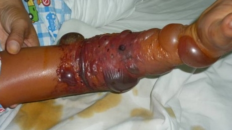 Đắp thuốc Đông y chữa bỏng, một trẻ nguy kịch