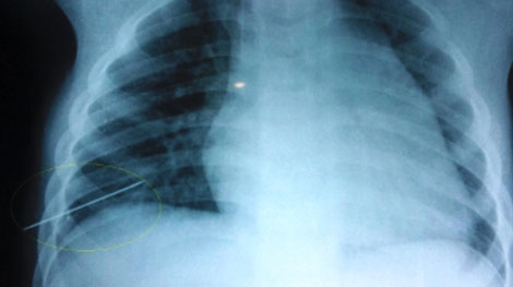 Cứu sống bé trai bị kim đâm thủng phổi