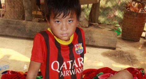 Cậu bé mồ côi người Mông dập nát chân bị hoại tử đã được phẫu thuật miễn phí