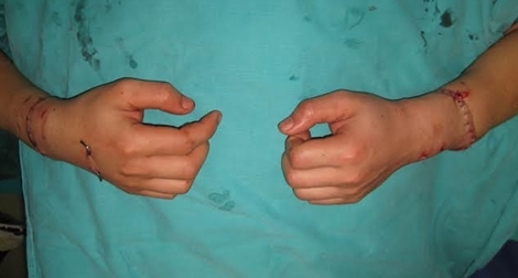 Bệnh viện Việt Đức nối thành công 2 cẳng tay đứt rời