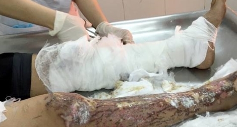 Tạt axit người tình vì  ghen tuông mù quáng