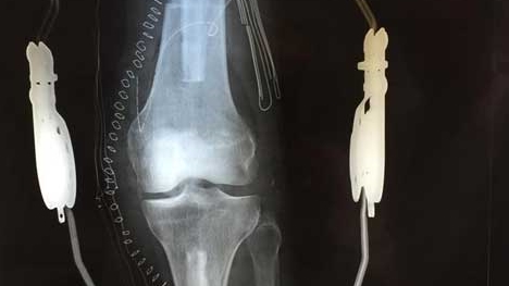 Ca cấy ghép đầu gối thành công đầu tiên trên thế giới