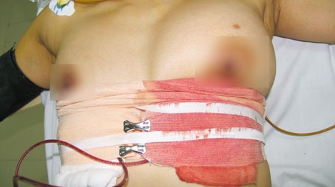 Phẫu thuật thẩm mỹ và những biến chứng… chết người