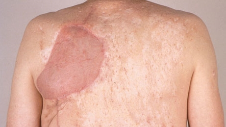 Da người chết được dùng trong chữa trị vết thương