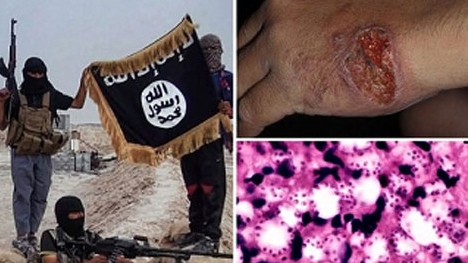 ‘Vi khuẩn ăn thịt’ đe dọa hơn 100 ngàn phiến quân Nhà nước Hồi giáo