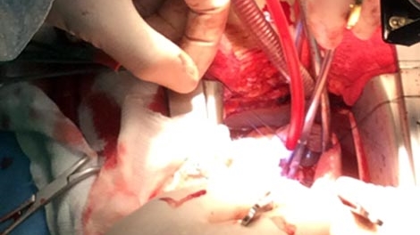 Phẫu thuật thành công ca thông liên nhĩ, tạo hình van 3 lá