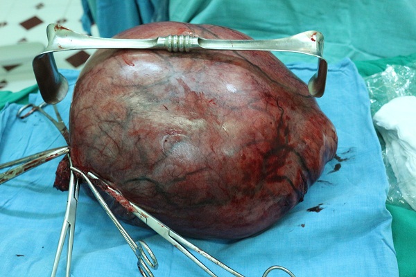 Choáng váng với khối u xơ tử cung "khổng lồ"