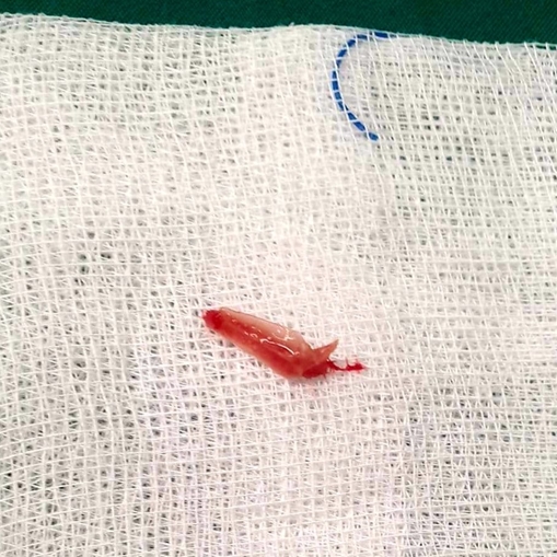 Mảnh xương cá lọt vào phổi bé trai 13 tháng tuổi