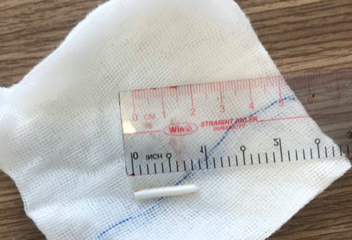 Nguy hiểm bé trai 18 tháng tuổi nuốt muống nhựa đồ chơi