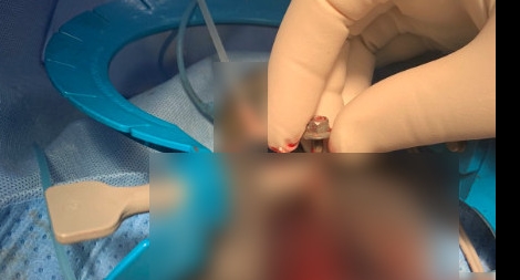 Hy hữu: Bị bạn nhậu nhét đinh vít dài 6cm vào niệu đạo 