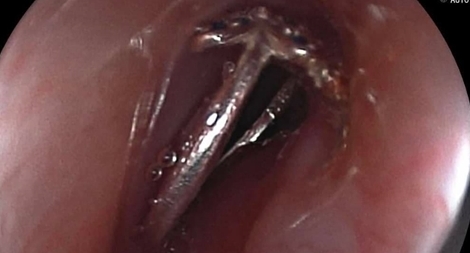 Kịp thời cấp cứu lấy chiếc nhẫn trong thực quản bệnh nhi