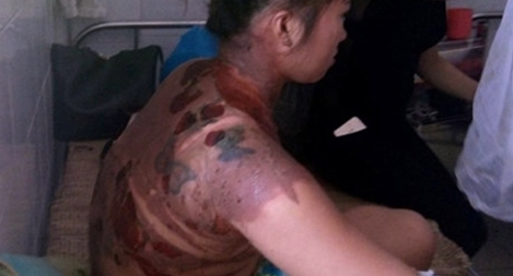 Người vợ bị chồng dội nước sôi nhiều vùng bỏng đến cấp độ 3