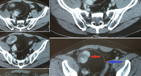 Nghẹt thở chạy đua cứu sống bệnh nhân mất máu không kiểm soát 