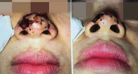 Ám ảnh "người đẹp phiên bản lỗi" từ… spa