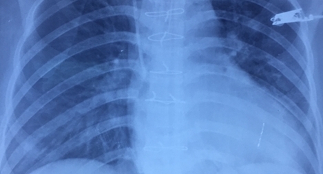 Bệnh viện Xuyên Á cứu sống nữ bệnh nhân bị cướp đâm thấu tim