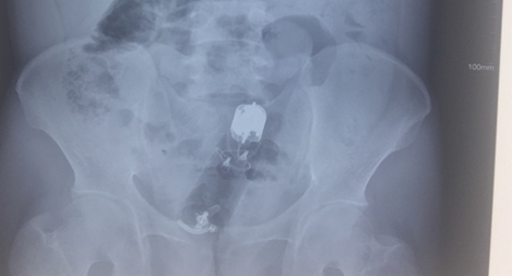 Cứu nam thanh niên bị mắc kẹt "đồ chơi tình dục" trong trực tràng