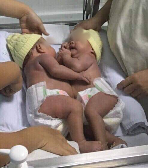 Tách dính cặp song sinh nhỏ nhất từ trước tới nay tại bệnh viện Nhi đồng 1