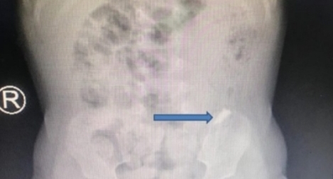 Bé trai 10 tháng tuổi nuốt miếng kính vỡ của gương soi