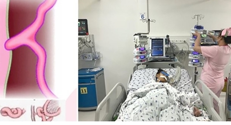 Cấp cứu bệnh nhi thoát vị nội hiếm gặp