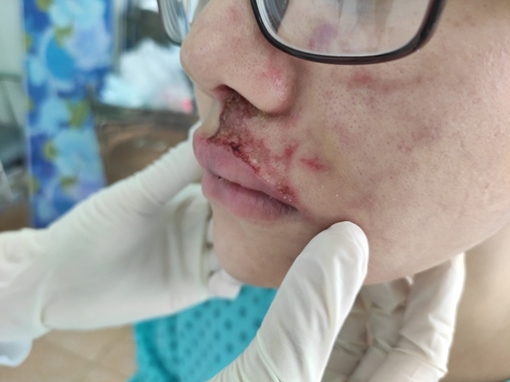 Mặt sưng phù, mưng mủ do tiêm filler làm đầy rãnh má