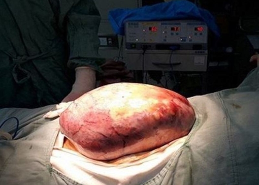 Bóc tách khối u buồng trứng "khổng lồ" cho cô gái 21 tuổi