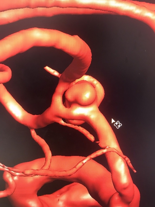 Cứu sống nữ bệnh nhân bị xuất huyết do vỡ phình mạch máu não