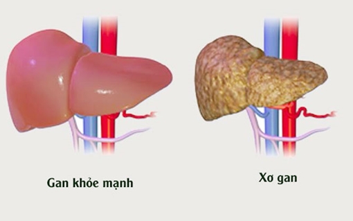 Khoảng 8,7 triệu người Việt Nam nhiễm vi rút viêm gan B